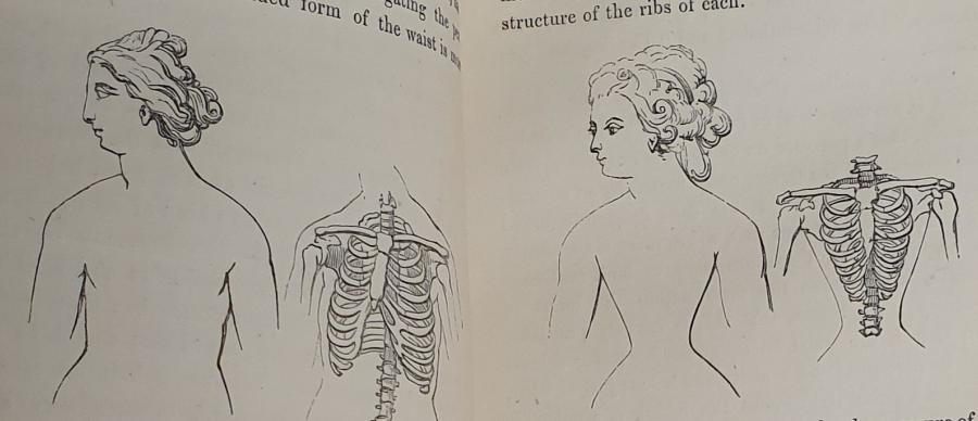 Showing the possible effects of a tight corset on a woman's body